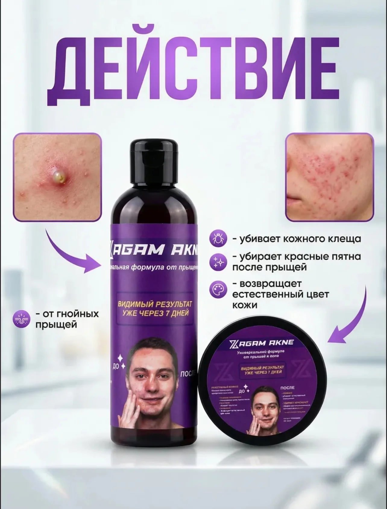 Средство от прыщей и акне